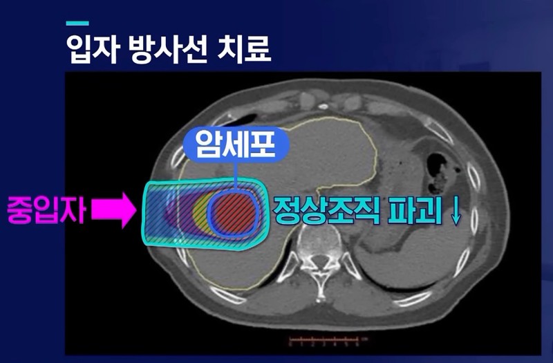 중입자-암치료-방식-사진