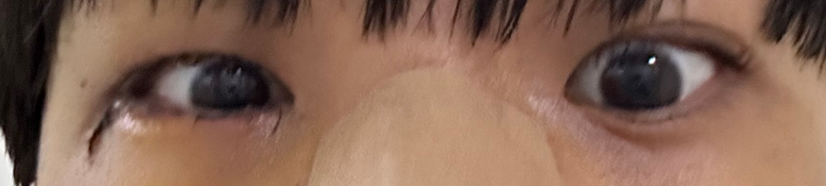 안와골절수술 사시 후기 안와골절 복시후기 광대뼈골절 통증 실밥제거