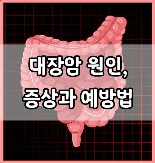  대장암 증상, 대장암의 원인과 위험인자, 대장암 예방법