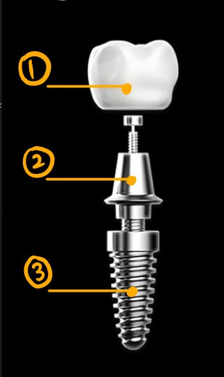 임플란트 구조