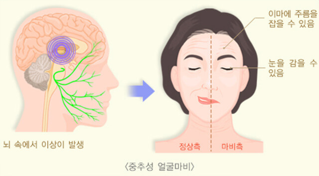 구안와사