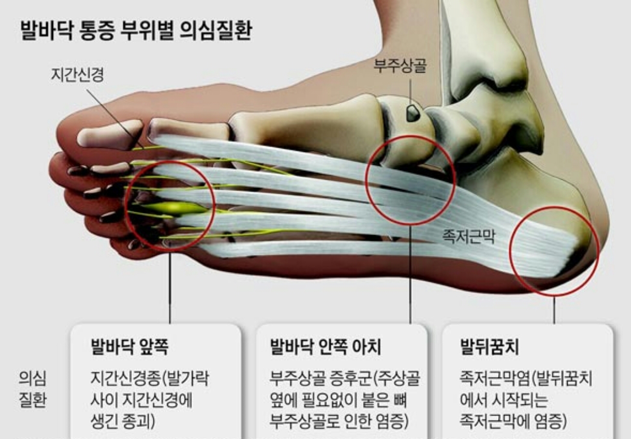 족저근막염