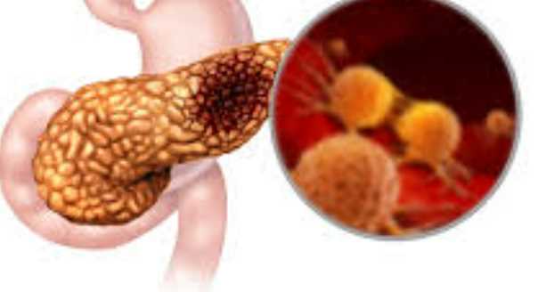 췌장암 초기증상 7가지