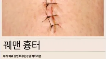흉터전용 치료 추천 스카덤 겔 효능효과_25
