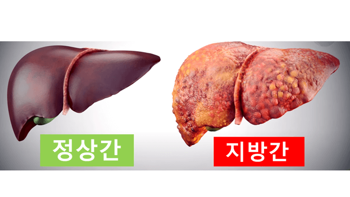 간 건강