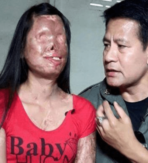 화상으로 얼굴 전체가 녹아내린 아내에게 사랑한다며 ‘뽀뽀’하는 남편, 그가 한 선택에 모두가 오열하고 말았습니다.