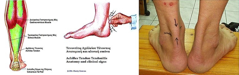 발뒤꿈치 통증 원인&#44; 증후군&#44; 부위별(왼쪽&#44; 오른쪽&#44; 위쪽&#44; 바닥)&#44; 운동후&#44; 치료 및 완화 한방에 정리