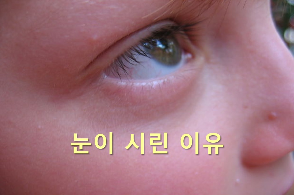  눈이 뿌옇게 보이는 증상과 눈이 시린 이유