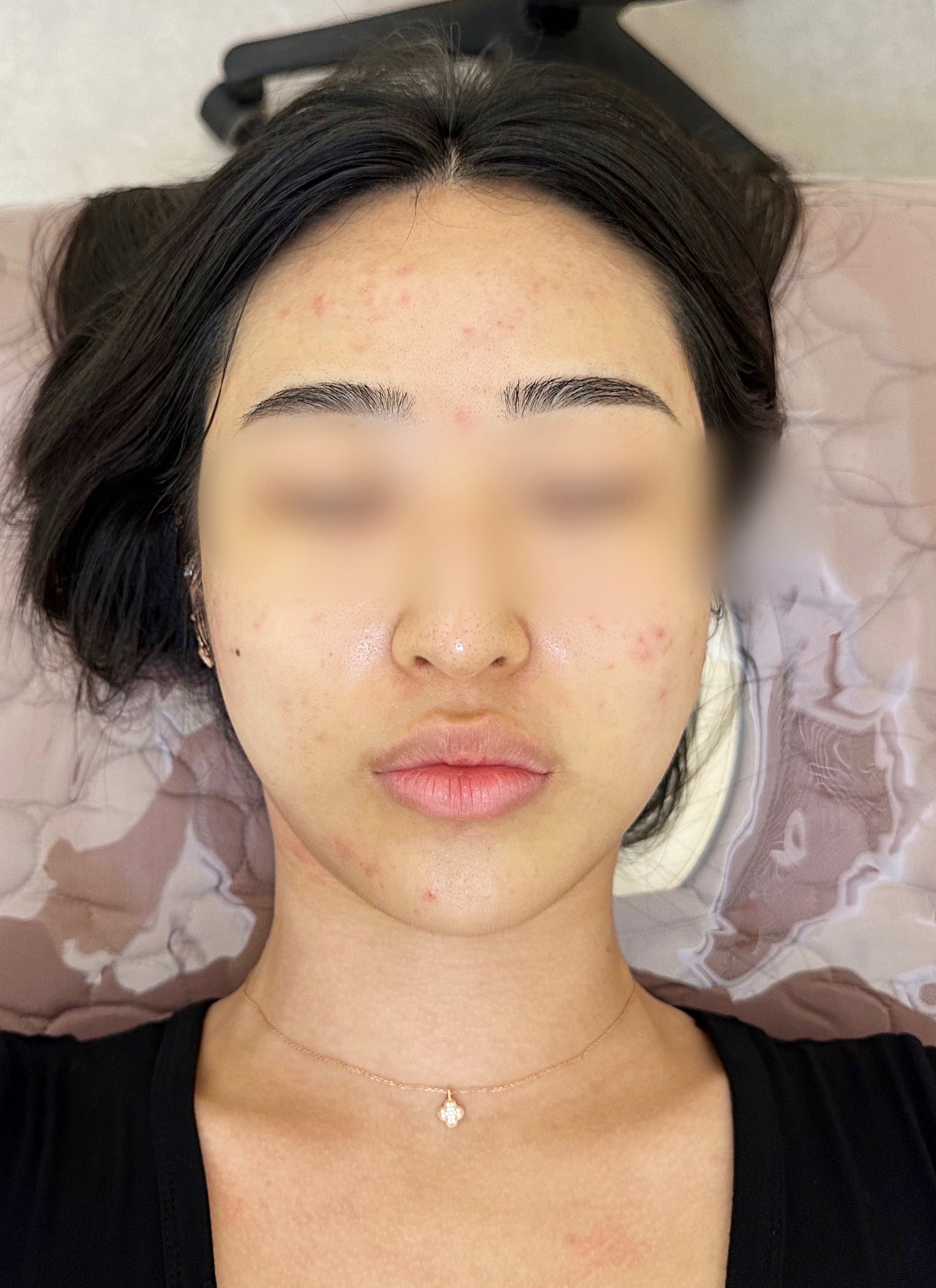  수원시청피부관리 사춘기 피부는 라이온미에서 해결!!