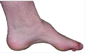 Charcomaritus 질병