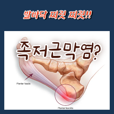 족저근막염 통증 완화 방법 6가지