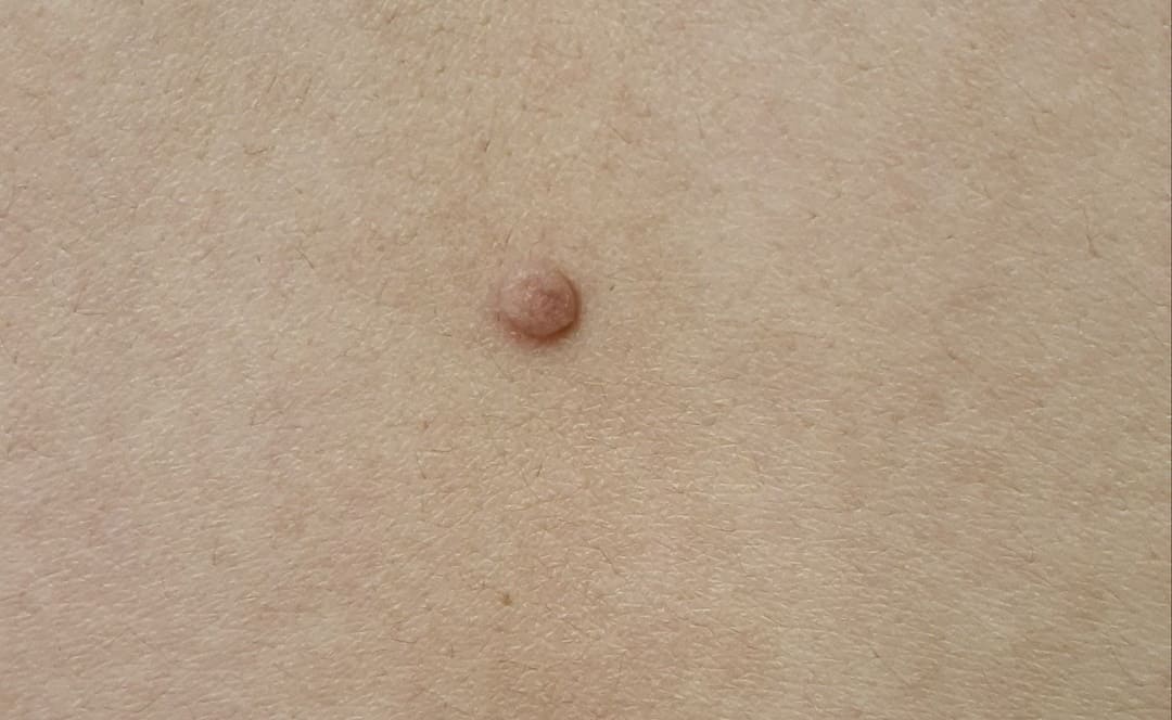  쥐젖 제거 비용과 원인, 연고보다는 레이저 치료