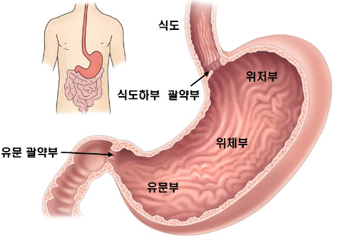 위축성 위염