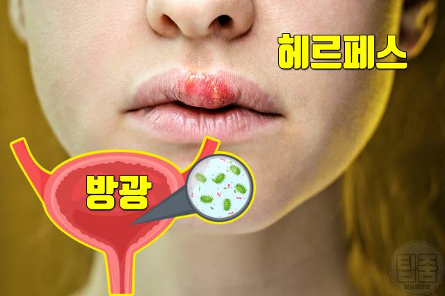 소변 볼때 따가움 따끔 따가워요 헤르페스