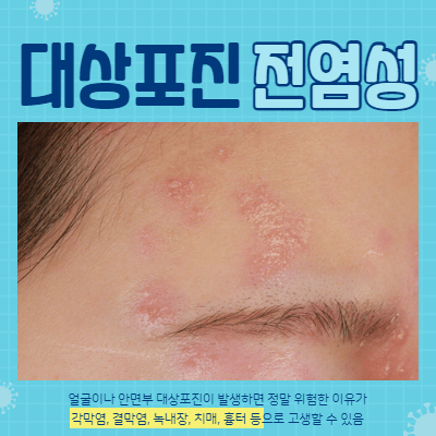  대상포진 전염성 있을까?