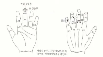 두통 수지침 편두통 혈자리_8