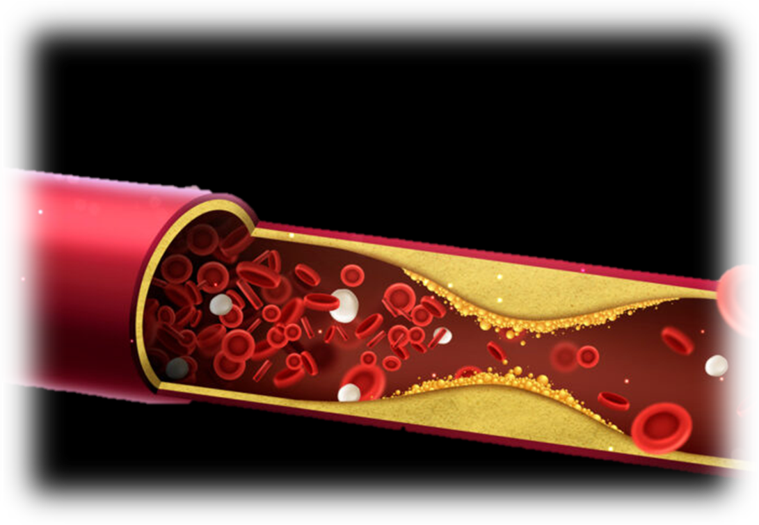 혈액 속에 과도한 지방 성분이 존재하여 혈관벽에 축적되고 염증을 유발하여 결국 심혈관 질환을 일으키는 상태.
