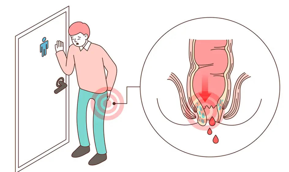 치질 증상과 예방법