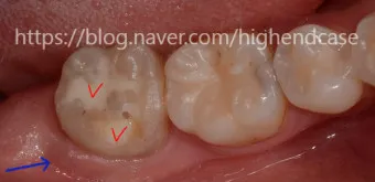 어금니 칫솔 사용법 선택방법 실사용 후기_20