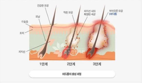 여드름원인