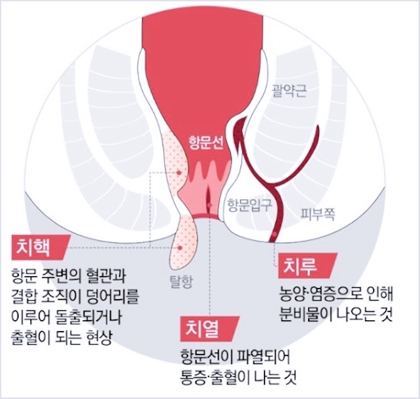 치질의 실제 비용은? 당신은 두 가지만 확인하면 됩니다.