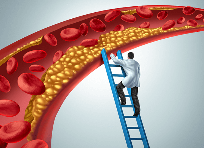 고콜레스테롤혈증