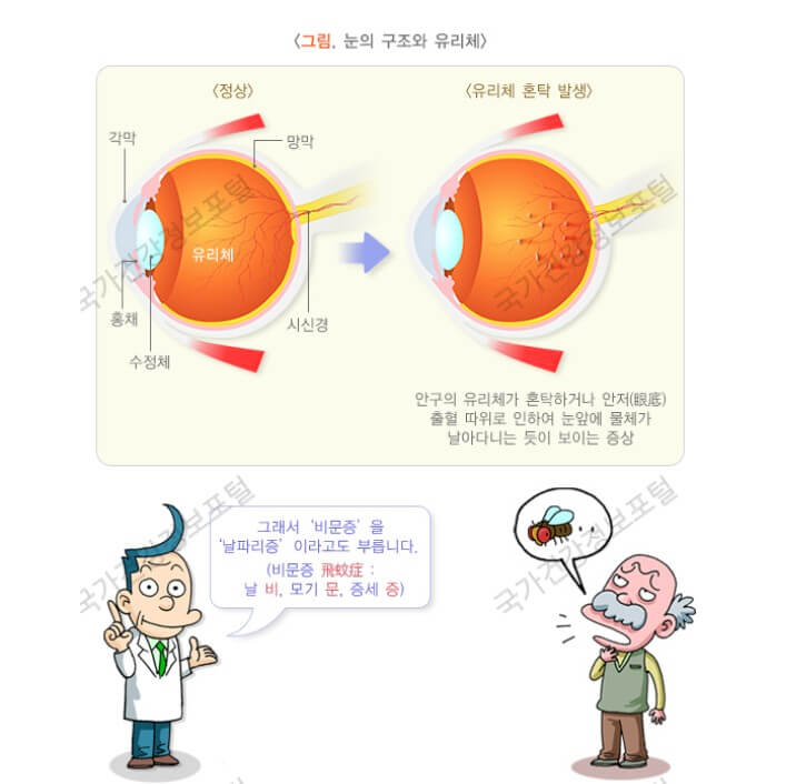 방치하면 실명