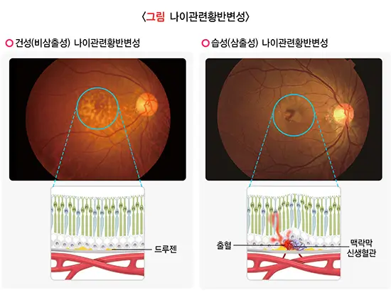 황반변성 자가 테스트, 원인 종류 증상 예방 치료방법