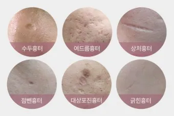 흉터전용 치료 추천 스카덤 겔 효능효과_21