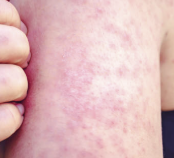 남성의 헤르페스 2형