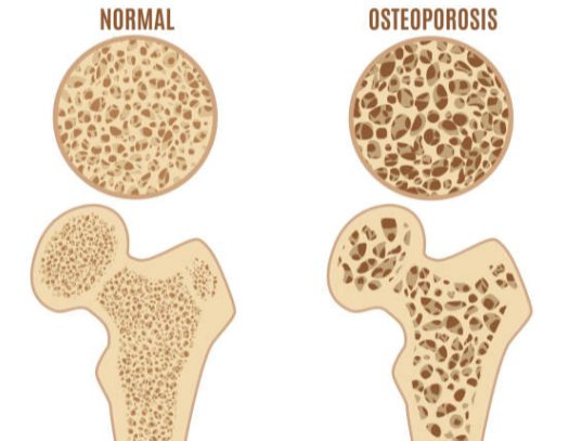 normal Vs osteoporosis