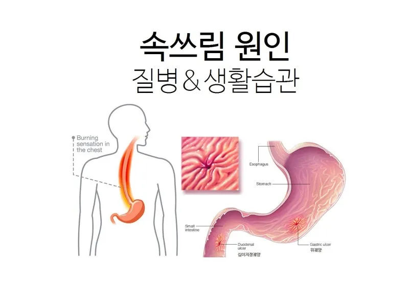 속쓰림 원인 증상 치료하는 방법_9