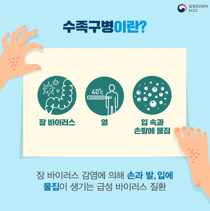 수족구증상-원인-치료방법