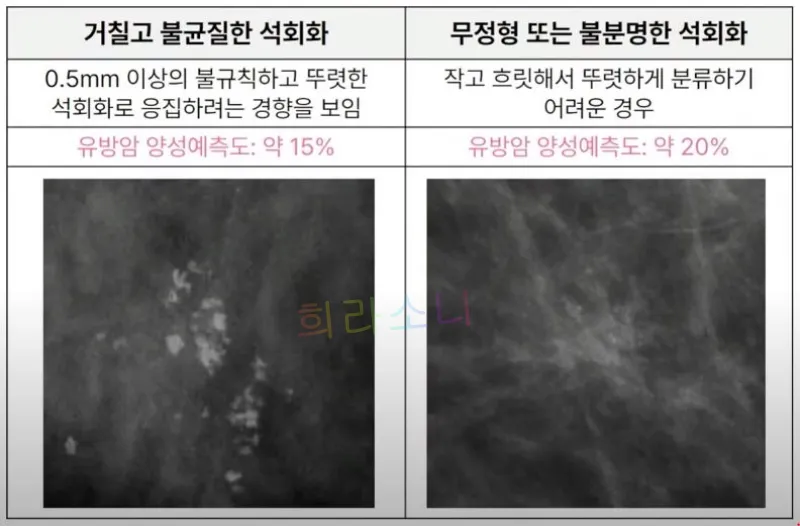 악성 유방 미세석회들의 모습. 거칠고 불균질한 석회화&amp;#44; 무정형 또는 불분명한 석회화