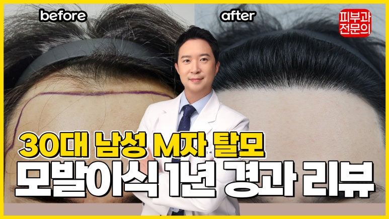M자 탈모 모발이식 디자인 포인트는!? 한 끗 차이로 인상이 달라집니다!