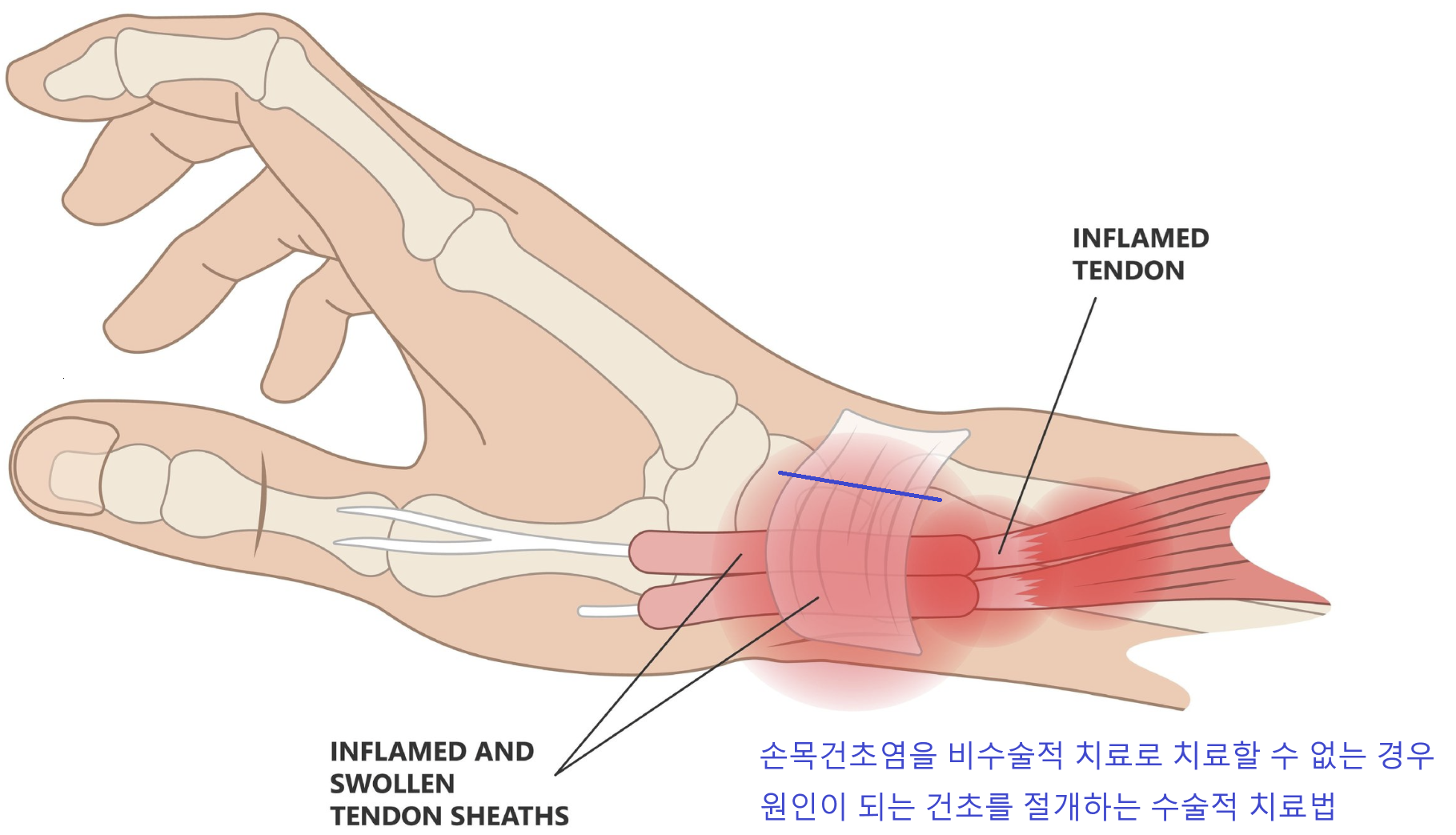 원인이 되는 건초를 절개하는 수술적 치료법 예시