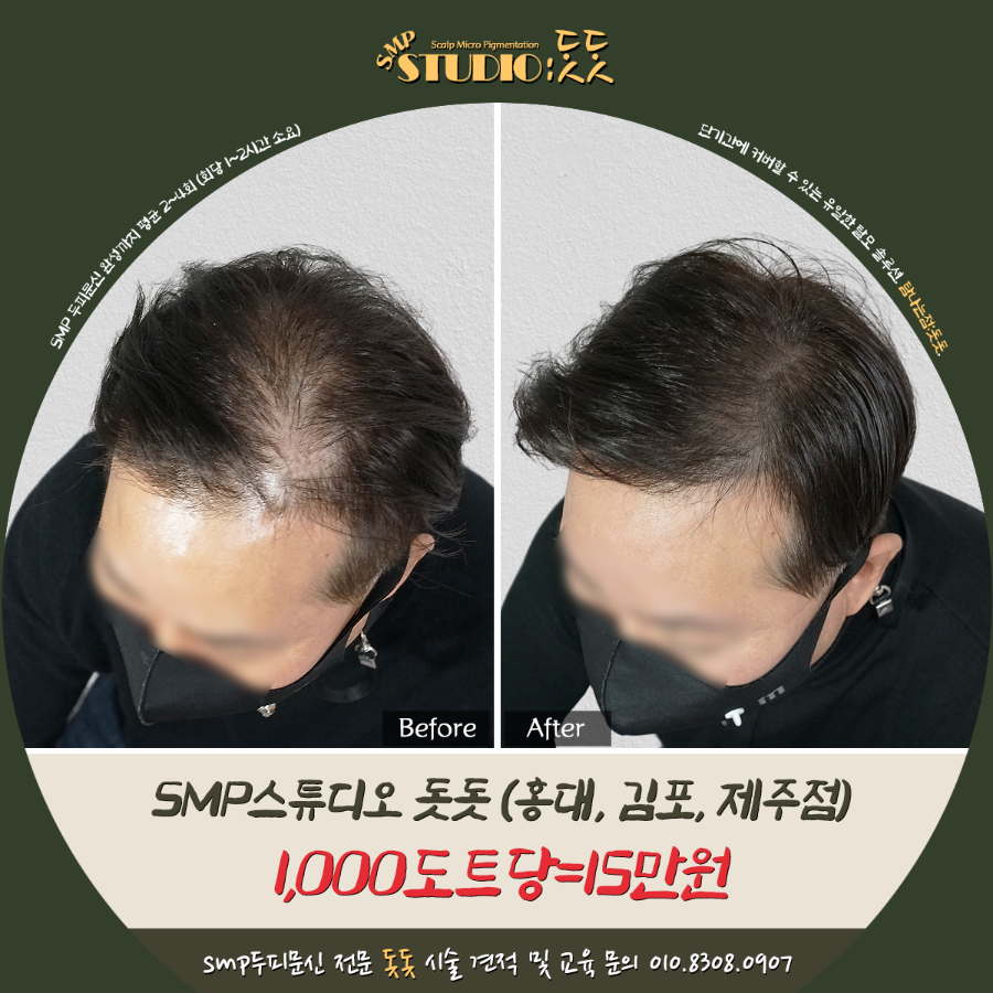  40대 남자 정수리 탈모 김포 두피문신 돗돗에서 숱 채우기