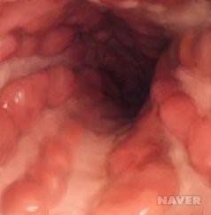  미스터트롯 영기 크론병? 크론병 줄기세포치료제를 코로나19에 사용?