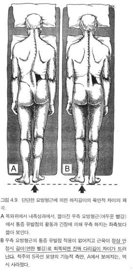 요방형근의 단축으로 인해서 다리길이 차이를 보여주는 그림