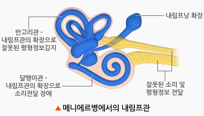 메니에르병 원인