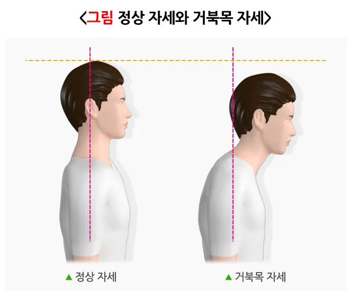거북목 증상 치료법 스트레칭_6