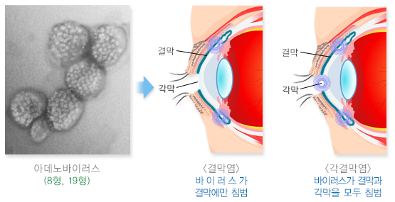 유행각결막염-원인-설명하는-사진