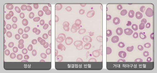 빈혈 종류