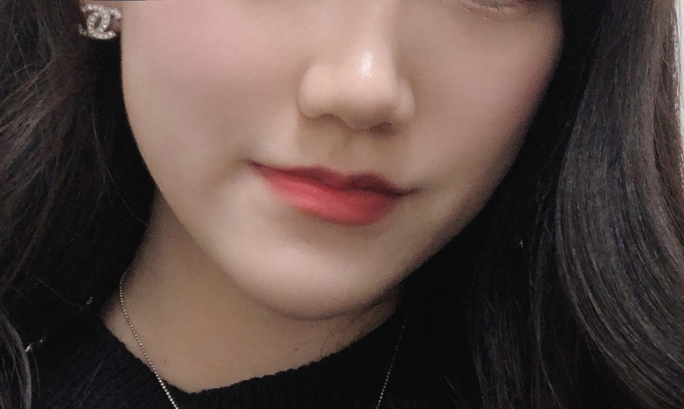 2차 코 봉오리 축소 코 조각 주사 후기교대역피부과 1개월 반 지났어 4