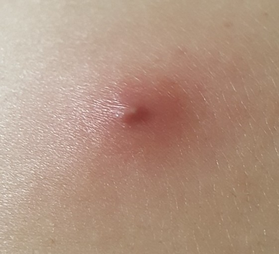 종기(furuncle), 항생제를 먹어야 되나? 말아야 되나?
