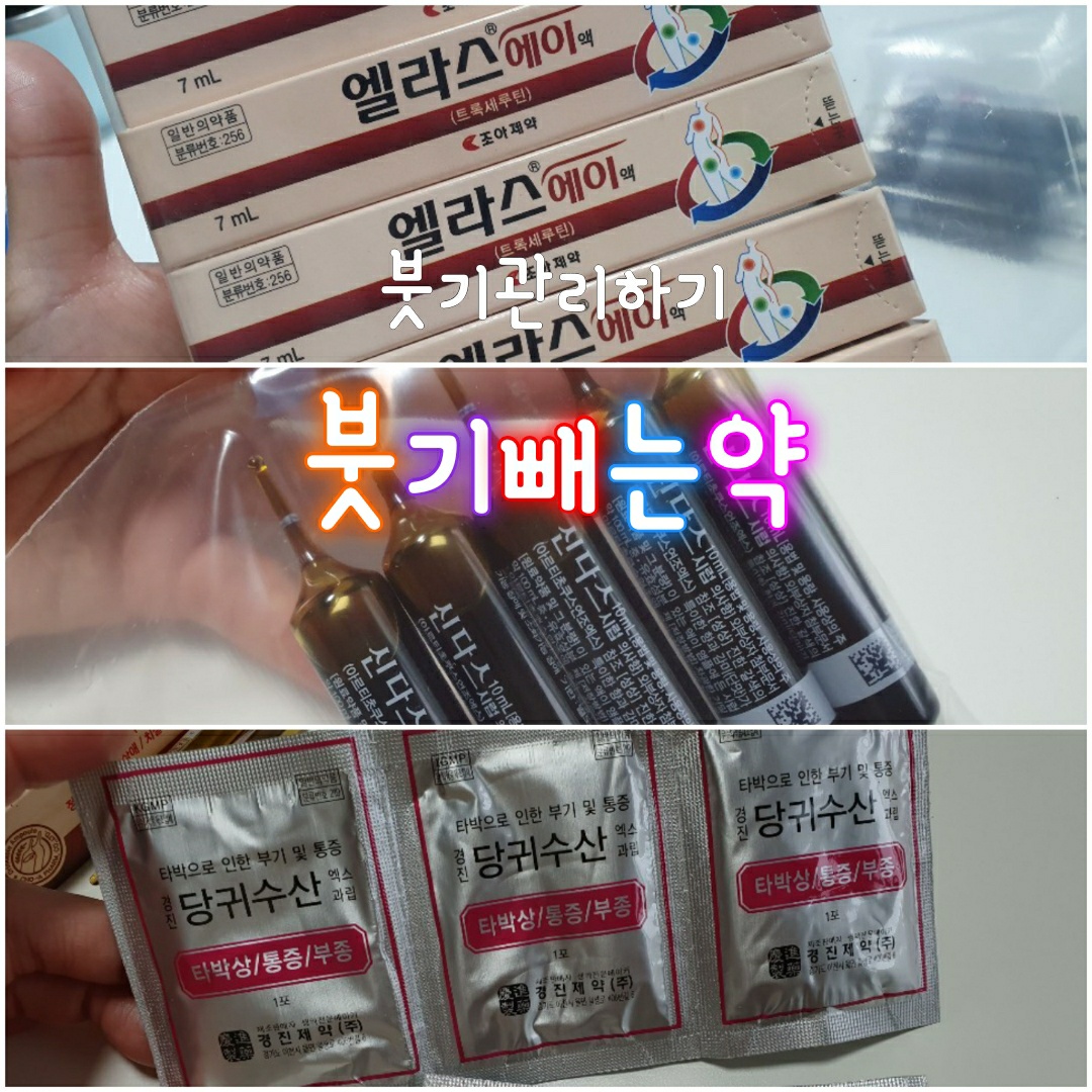  얼굴, 발 등 붓기 관리하기 부종, 부기 빼는 약, 성형 후 붓기 제거 추천