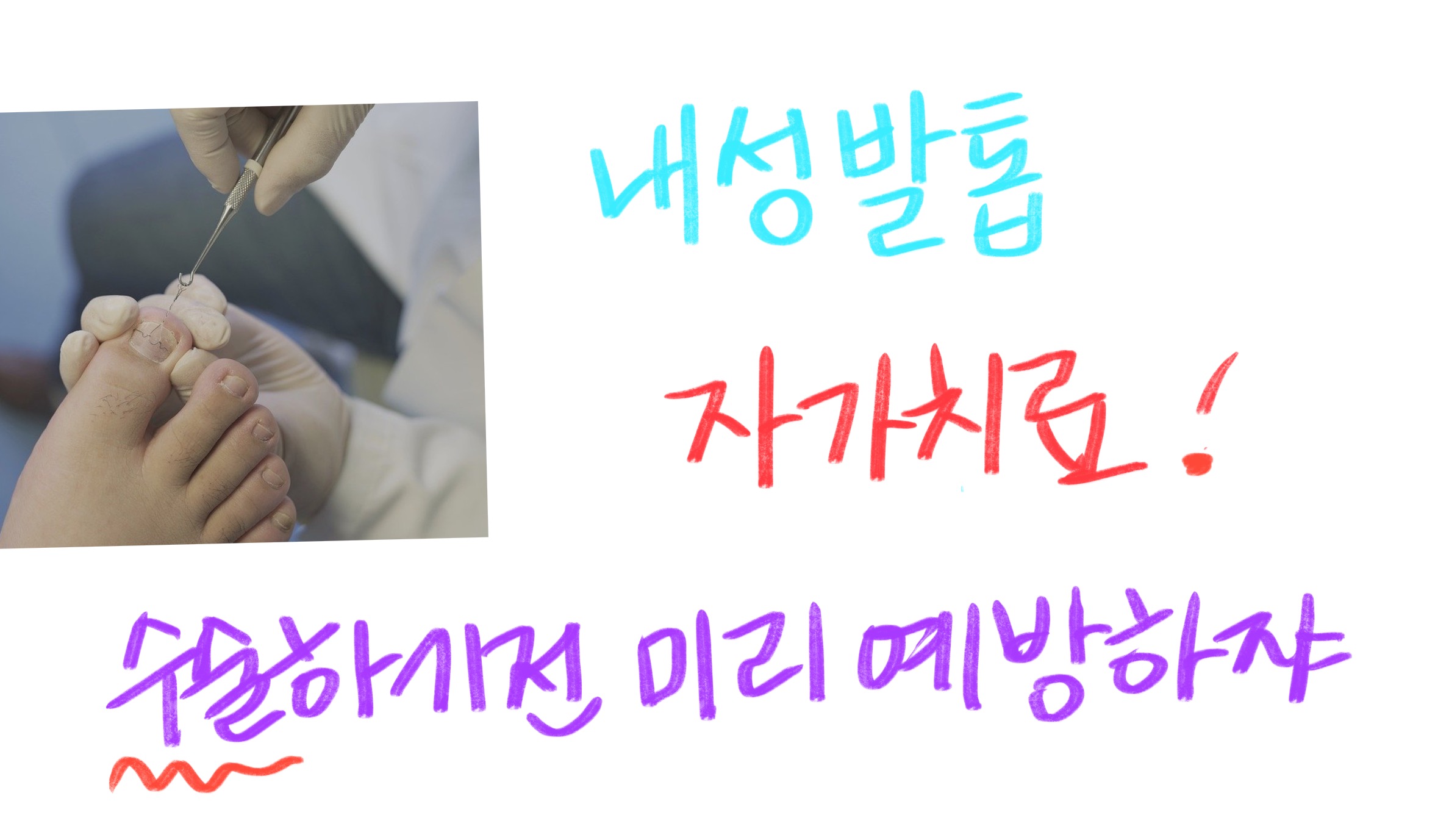  내성발톱 자가치료 , 미리미리 예방하자