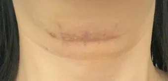 흉터전용 치료 추천 스카덤 겔 효능효과_15