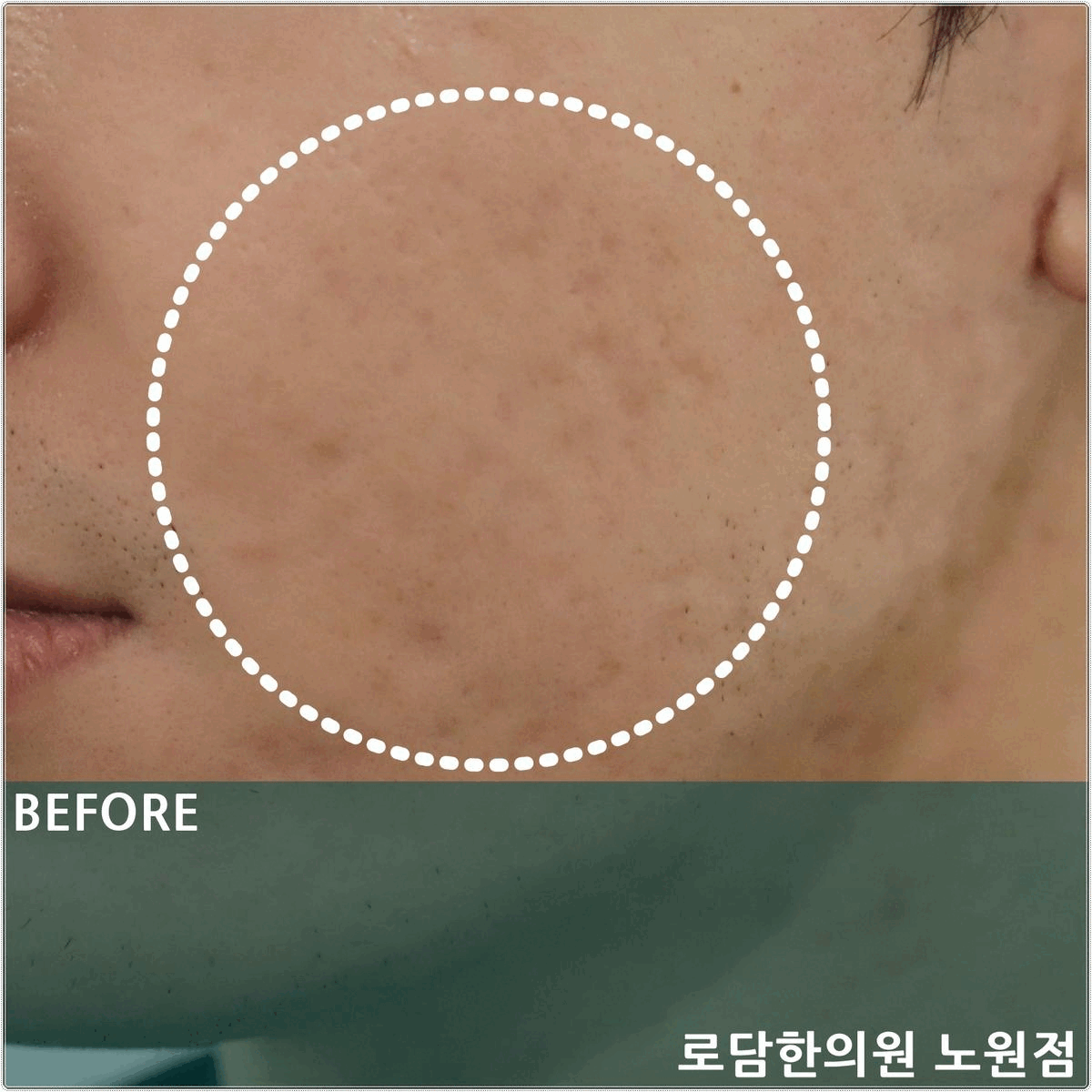  노원여드름흉터 패인 흉터 한의원 새살침 치료를 통해