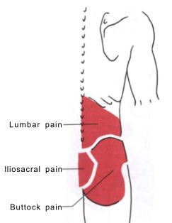 허리와 둔부 통증을 나타내는 부위를 표시 해놓은 그림